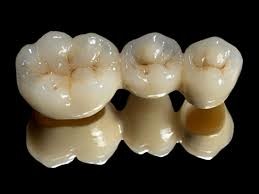 Protesi dentali fisse tradizionali (Corone)